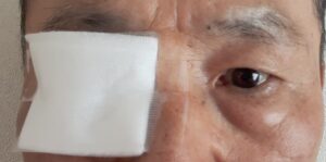 涙道手術後眼帯